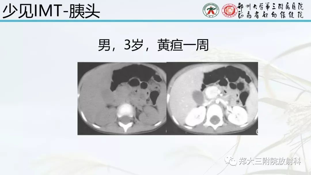 【PPT】炎性肌纤维母细胞瘤的影像表现 【PPT】炎性肌纤维母细胞瘤的影像表现