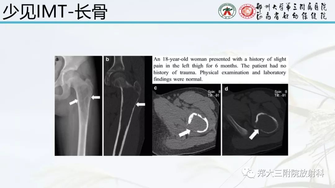 【PPT】炎性肌纤维母细胞瘤的影像表现 【PPT】炎性肌纤维母细胞瘤的影像表现