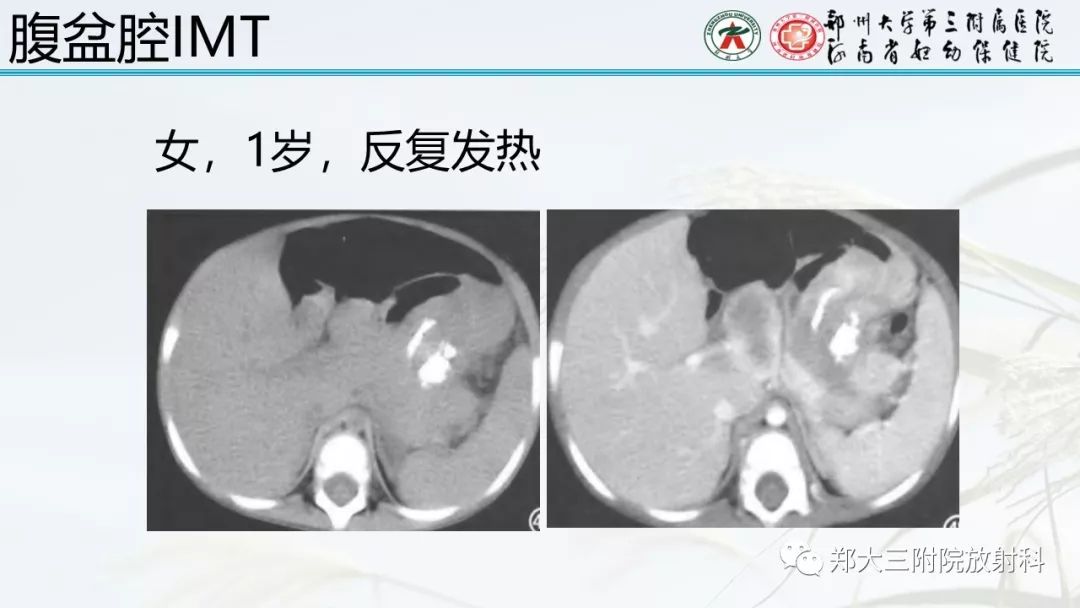 【PPT】炎性肌纤维母细胞瘤的影像表现 【PPT】炎性肌纤维母细胞瘤的影像表现