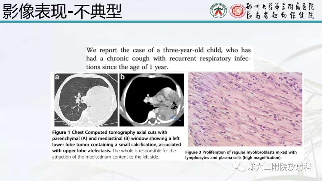 【PPT】炎性肌纤维母细胞瘤的影像表现 【PPT】炎性肌纤维母细胞瘤的影像表现