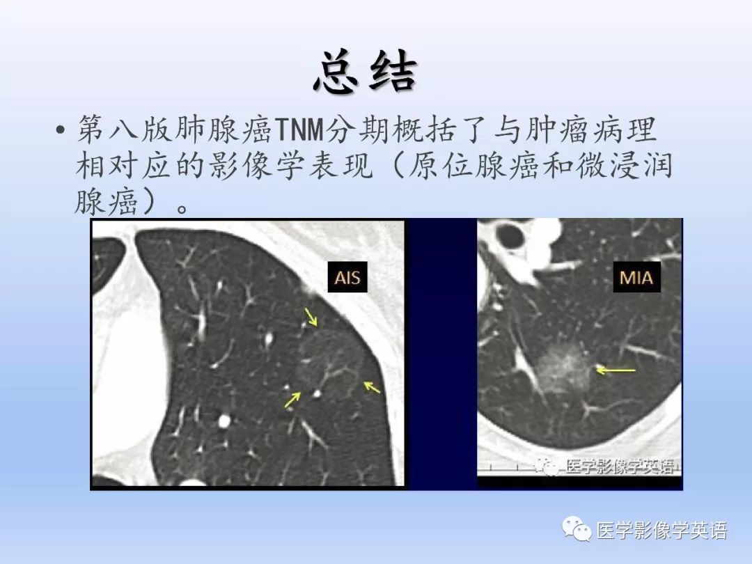 【PPT】第八版肺腺癌TNM分期影像学解读