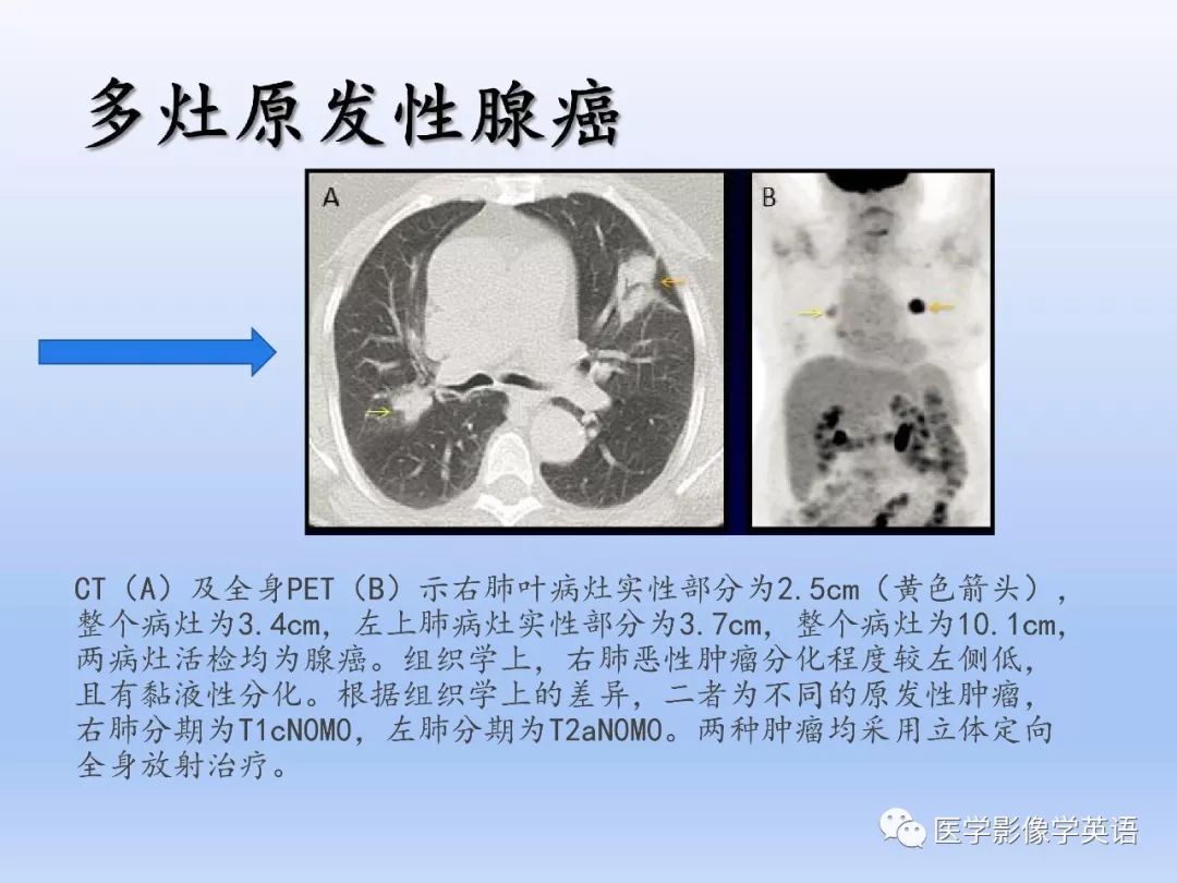 【PPT】第八版肺腺癌TNM分期影像学解读
