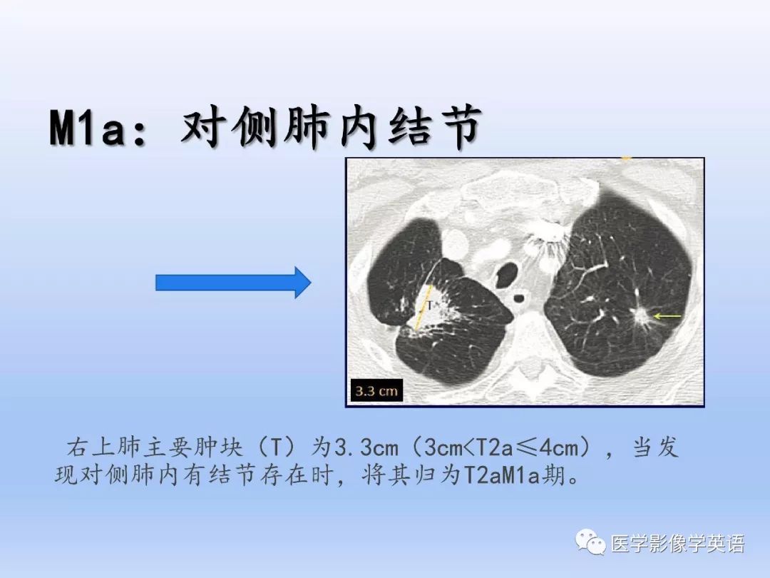 【PPT】第八版肺腺癌TNM分期影像学解读