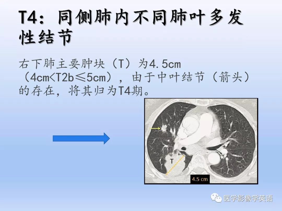 【PPT】第八版肺腺癌TNM分期影像学解读