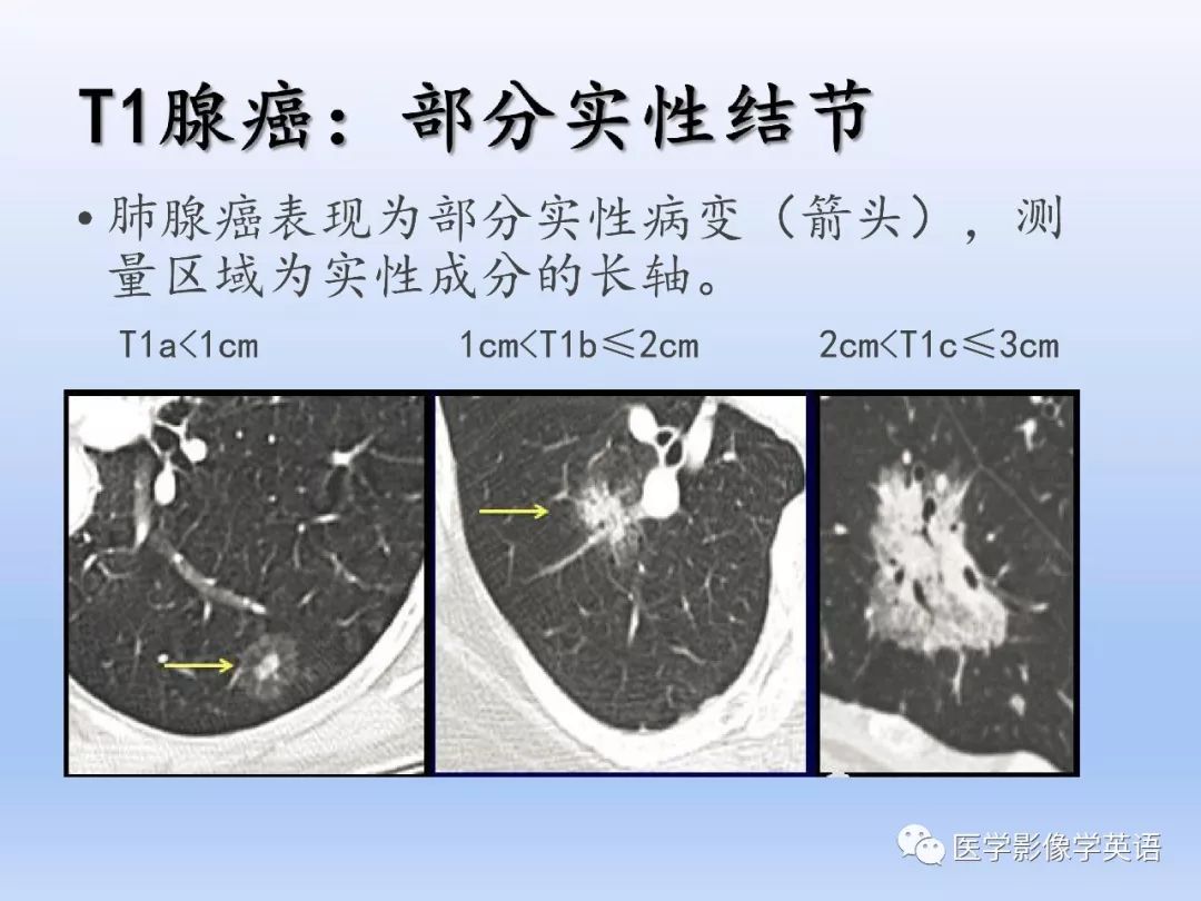 【PPT】第八版肺腺癌TNM分期影像学解读