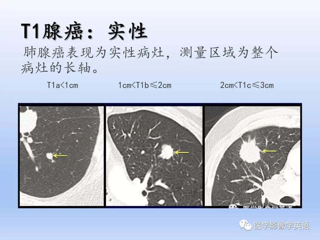【PPT】第八版肺腺癌TNM分期影像学解读