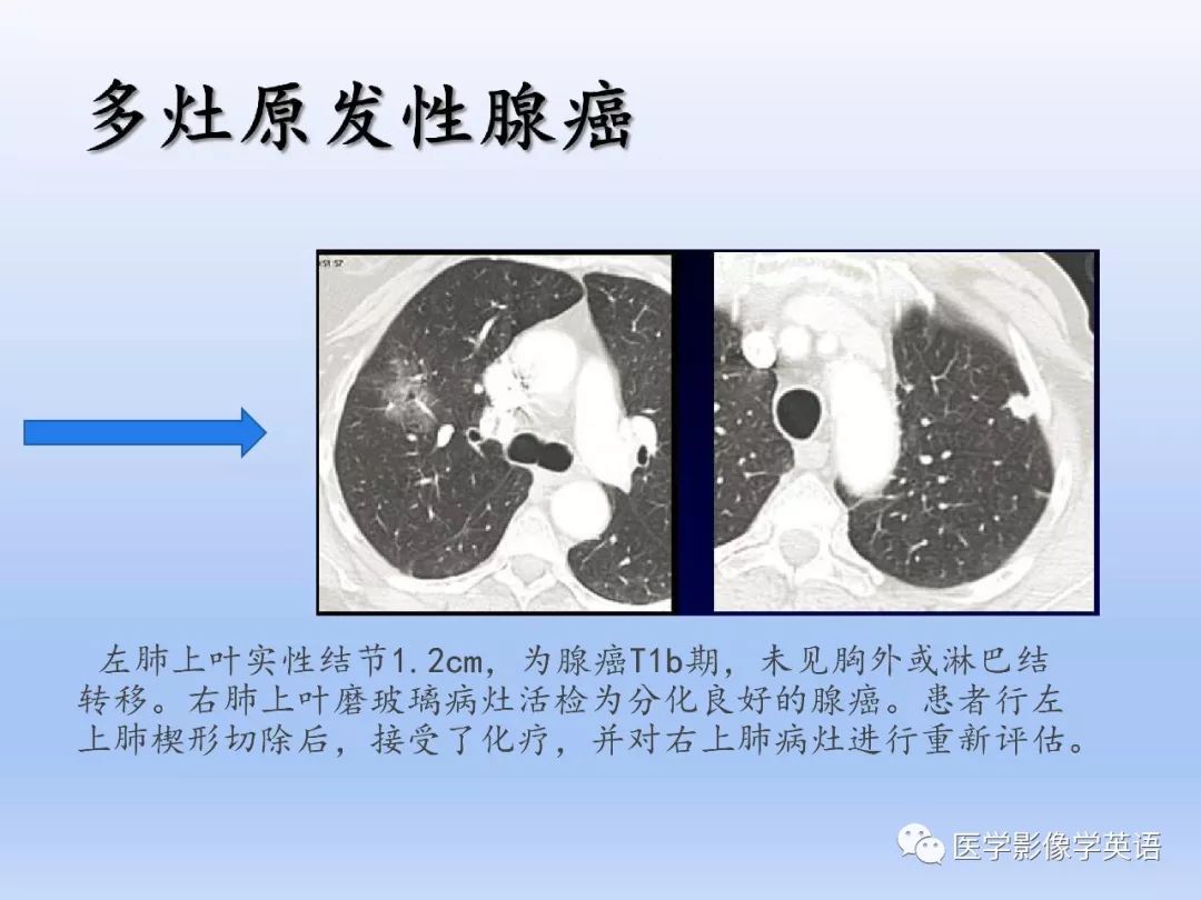 【PPT】第八版肺腺癌TNM分期影像学解读