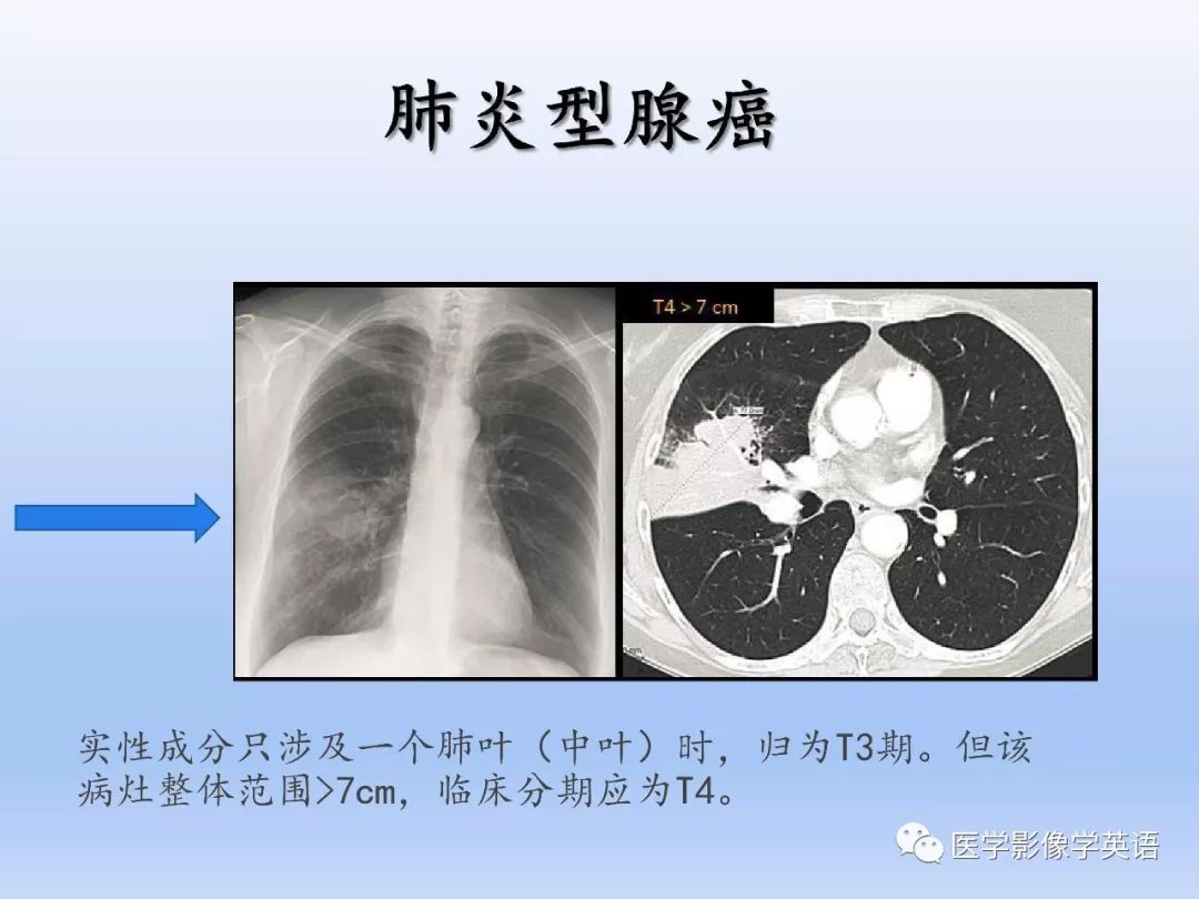 【PPT】第八版肺腺癌TNM分期影像学解读