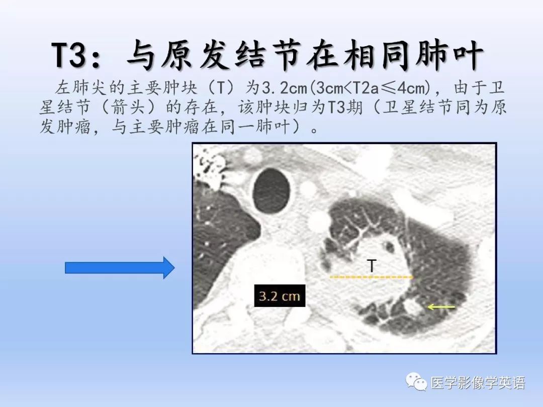 【PPT】第八版肺腺癌TNM分期影像学解读