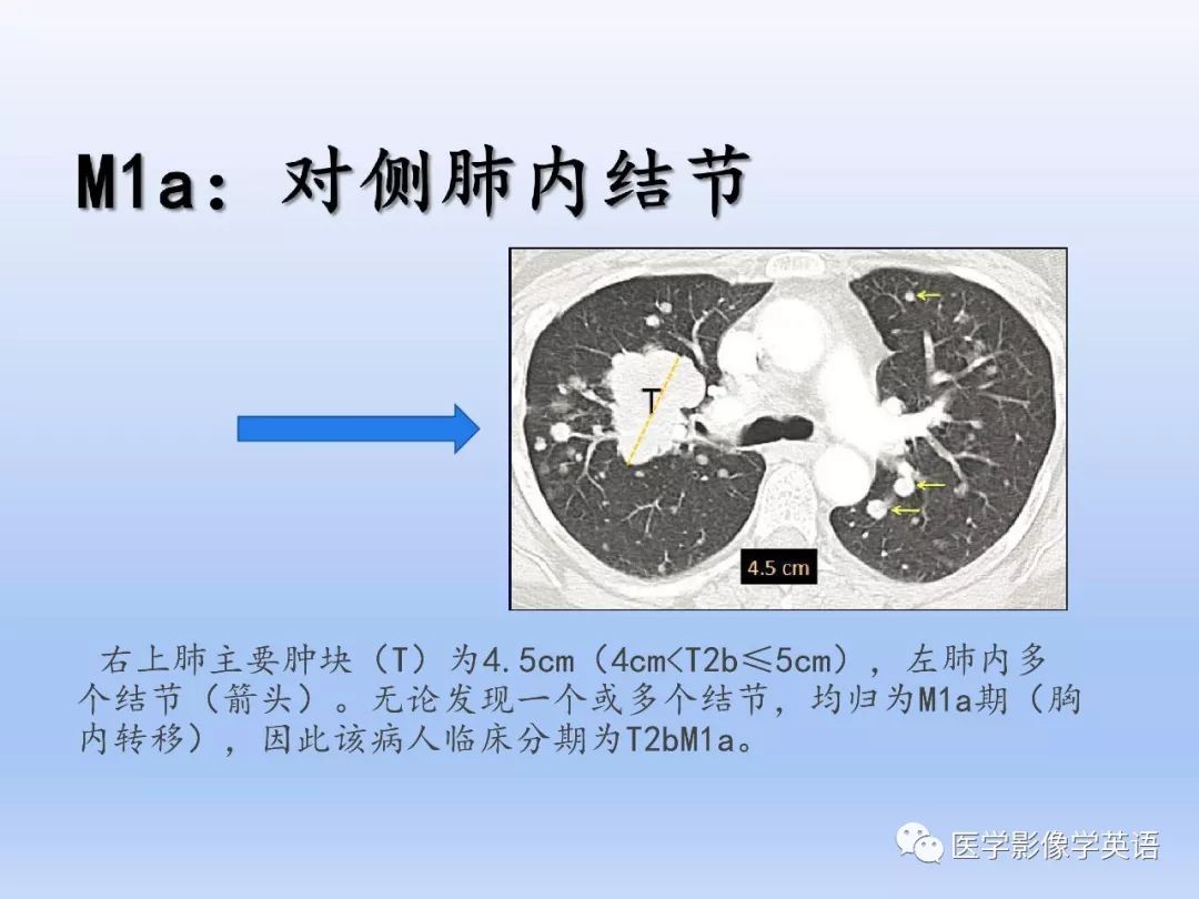 【PPT】第八版肺腺癌TNM分期影像学解读