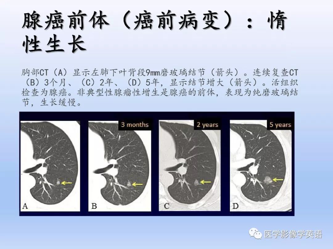 【PPT】第八版肺腺癌TNM分期影像学解读