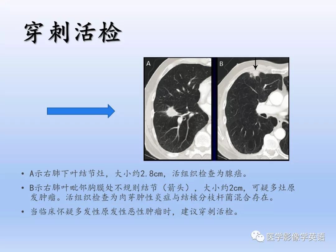 【PPT】第八版肺腺癌TNM分期影像学解读