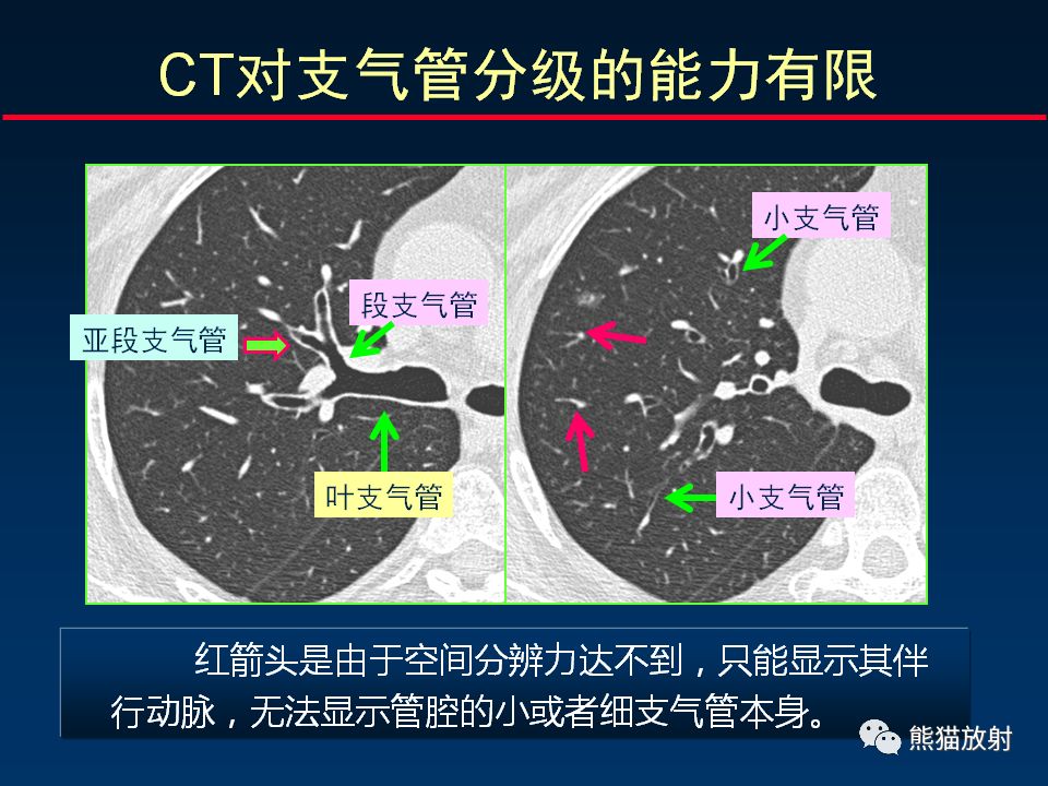 【PPT】正确判读支气管异常的CT征象 【PPT】正确判读支气管异常的CT征象