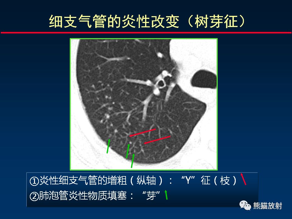 【PPT】正确判读支气管异常的CT征象 【PPT】正确判读支气管异常的CT征象