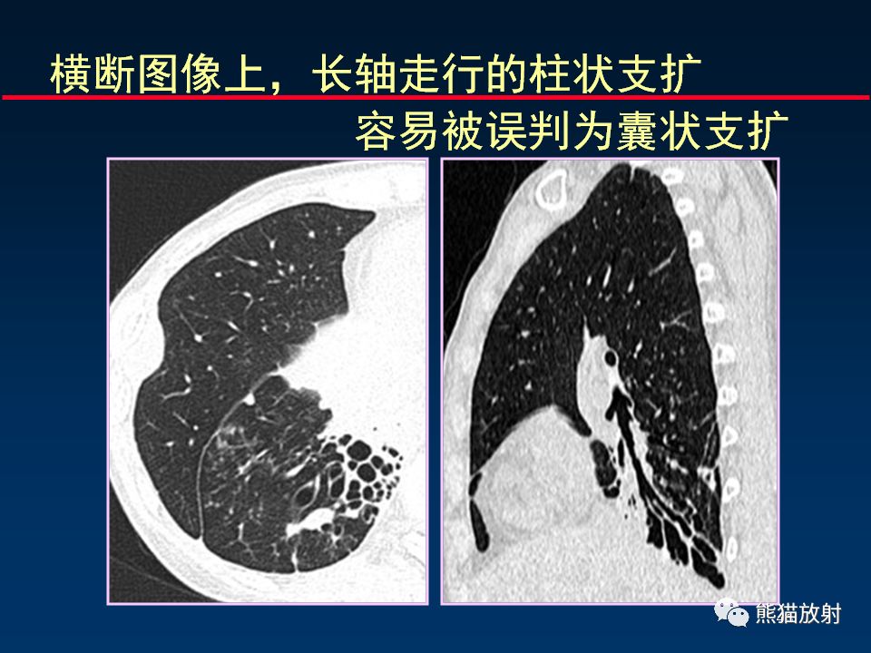 【PPT】正确判读支气管异常的CT征象 【PPT】正确判读支气管异常的CT征象