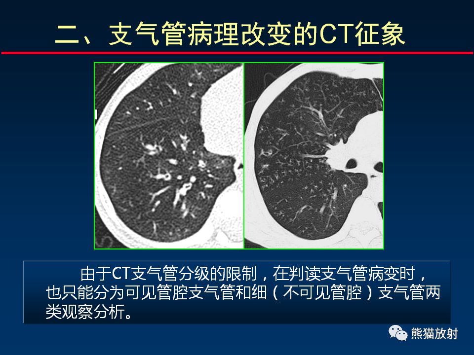 【PPT】正确判读支气管异常的CT征象 【PPT】正确判读支气管异常的CT征象