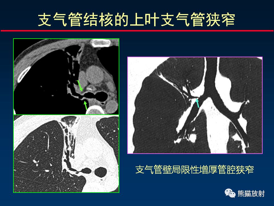 【PPT】正确判读支气管异常的CT征象 【PPT】正确判读支气管异常的CT征象