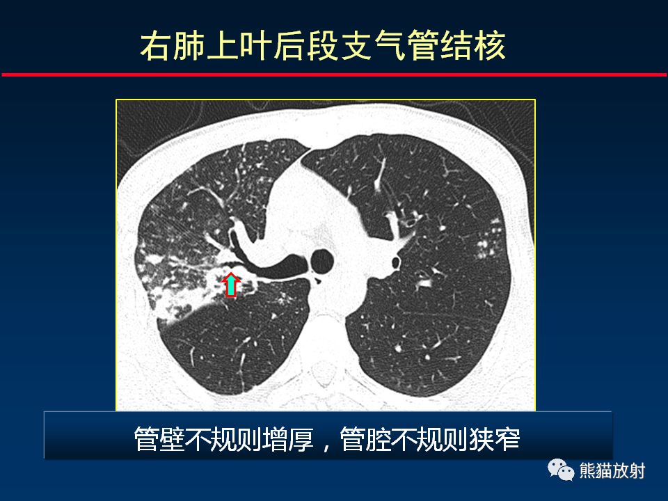 【PPT】正确判读支气管异常的CT征象 【PPT】正确判读支气管异常的CT征象