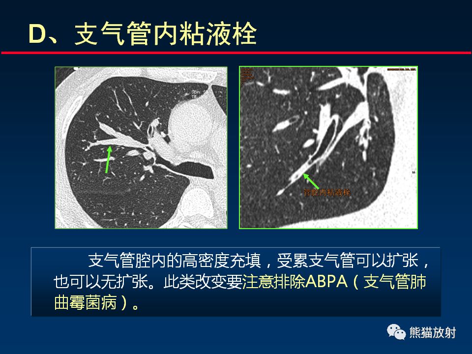 【PPT】正确判读支气管异常的CT征象 【PPT】正确判读支气管异常的CT征象