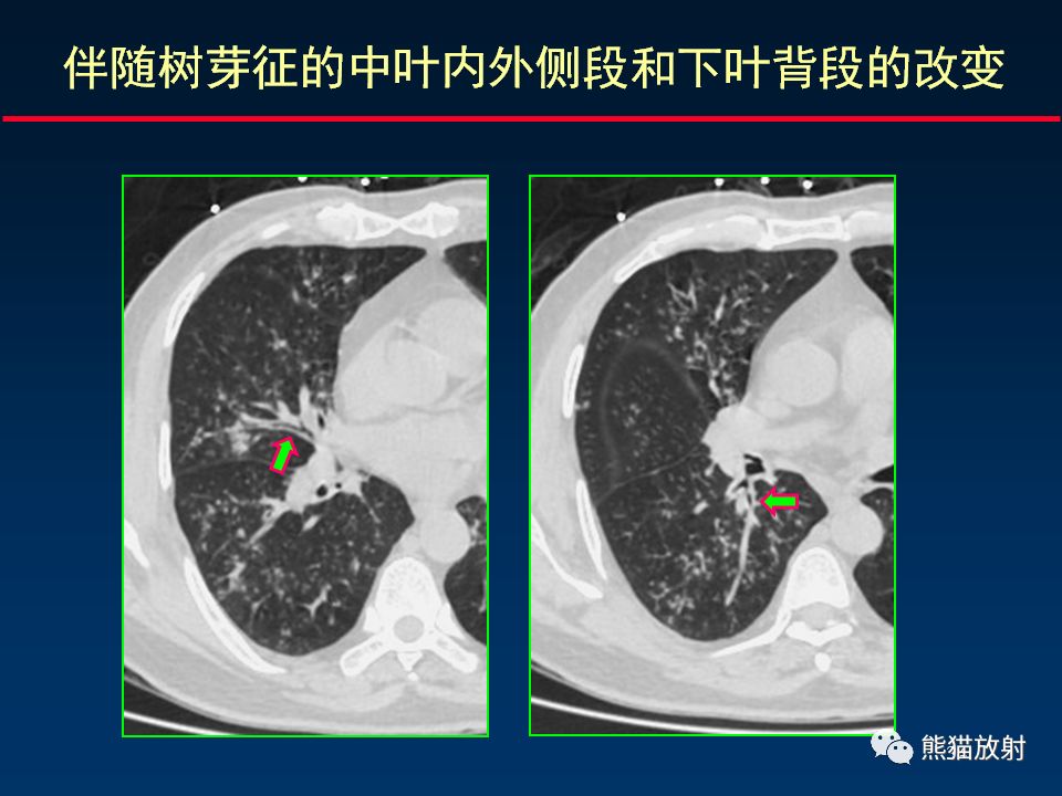 【PPT】正确判读支气管异常的CT征象 【PPT】正确判读支气管异常的CT征象