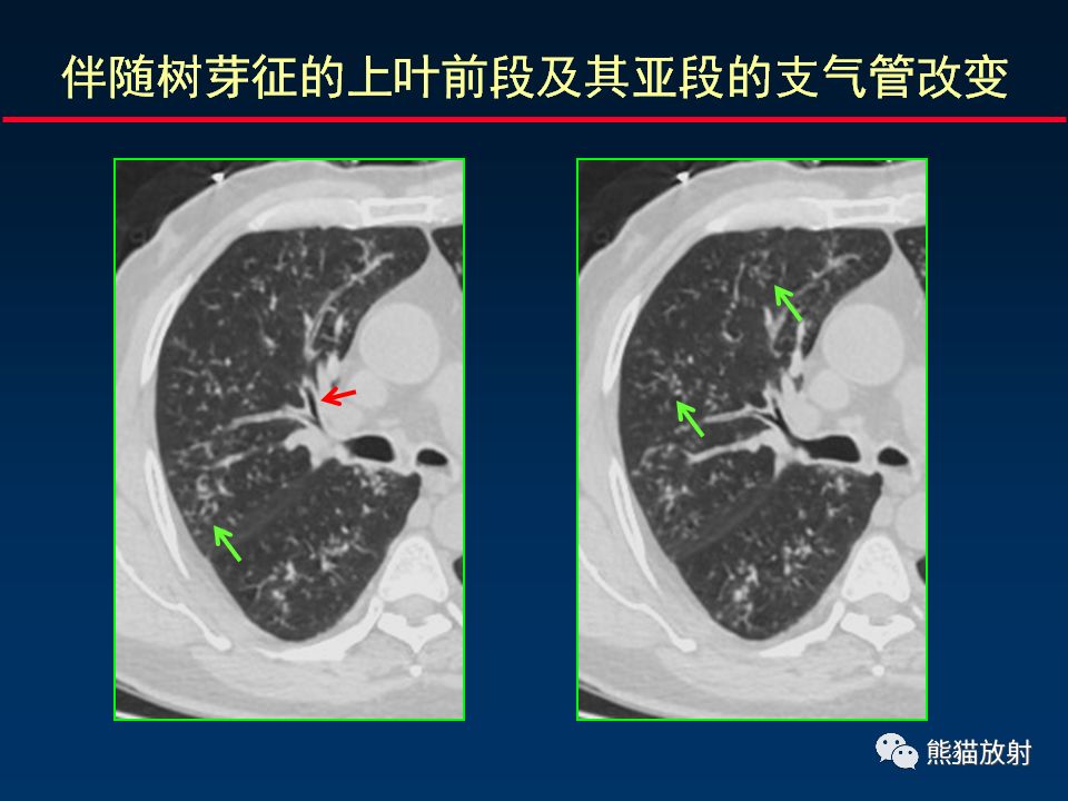 【PPT】正确判读支气管异常的CT征象 【PPT】正确判读支气管异常的CT征象