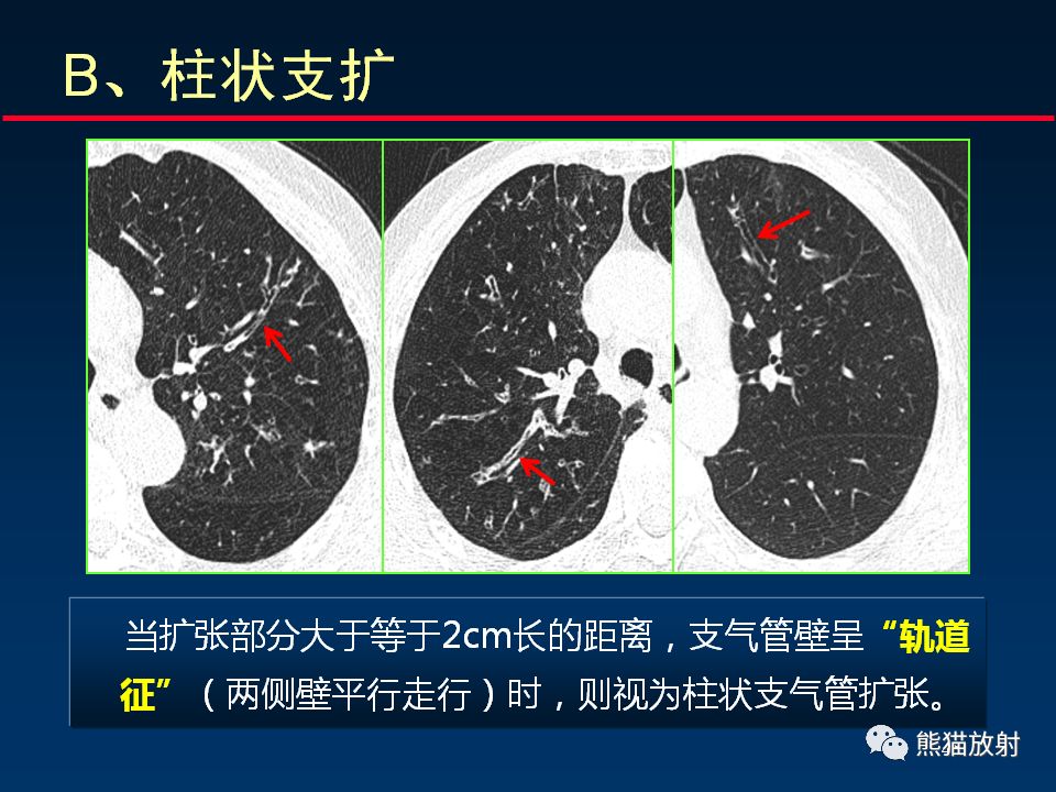 【PPT】正确判读支气管异常的CT征象 【PPT】正确判读支气管异常的CT征象