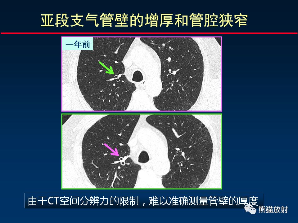 【PPT】正确判读支气管异常的CT征象 【PPT】正确判读支气管异常的CT征象