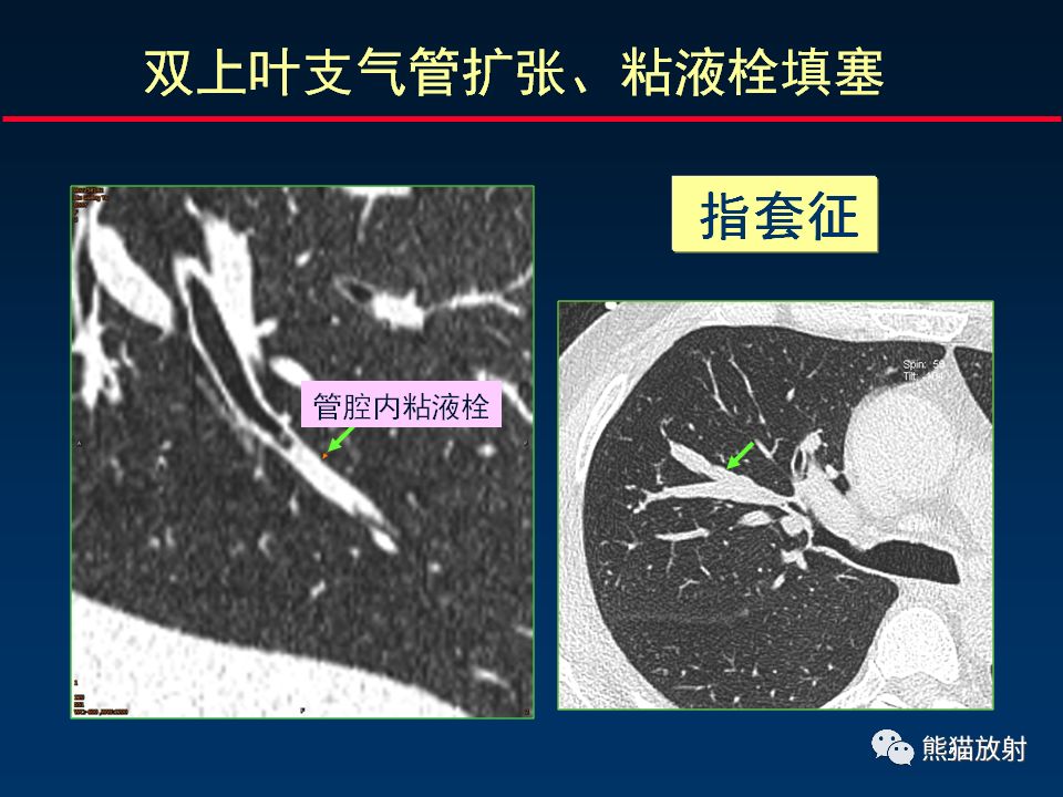 【PPT】正确判读支气管异常的CT征象 【PPT】正确判读支气管异常的CT征象