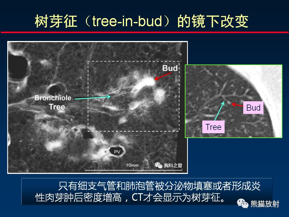 【PPT】正确判读支气管异常的CT征象 【PPT】正确判读支气管异常的CT征象