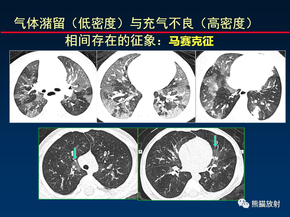 【PPT】正确判读支气管异常的CT征象 【PPT】正确判读支气管异常的CT征象