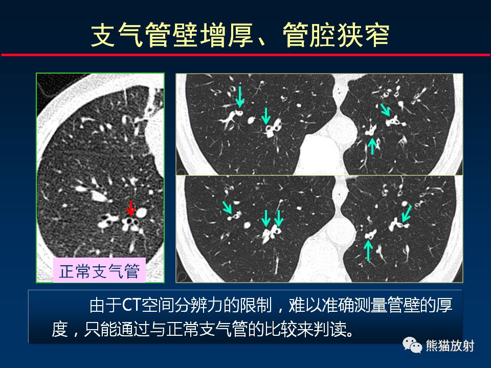 【PPT】正确判读支气管异常的CT征象 【PPT】正确判读支气管异常的CT征象