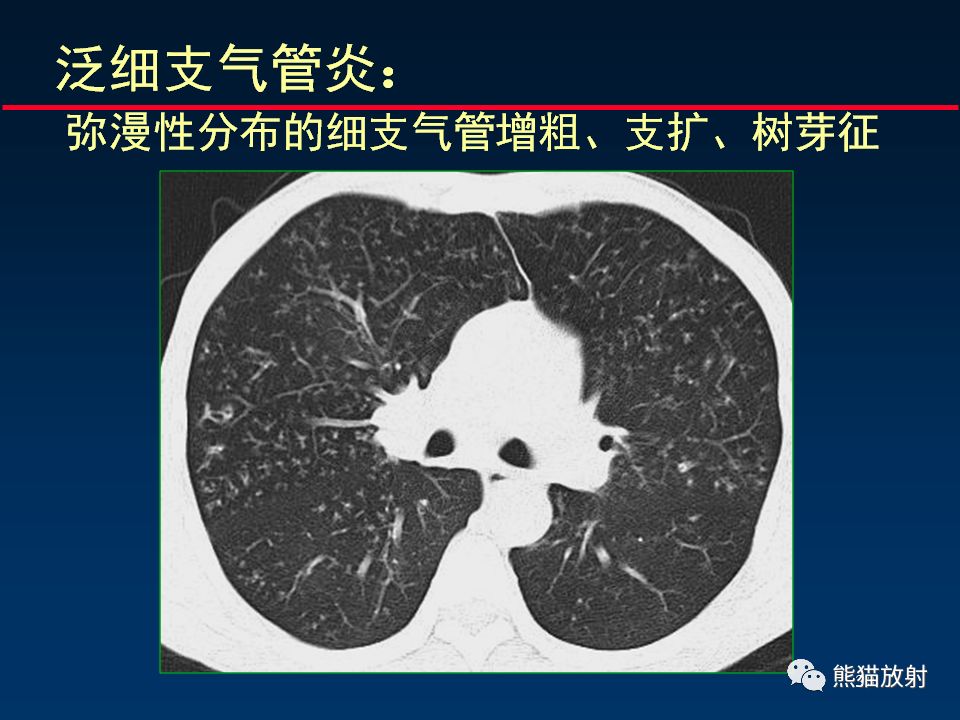 【PPT】正确判读支气管异常的CT征象 【PPT】正确判读支气管异常的CT征象