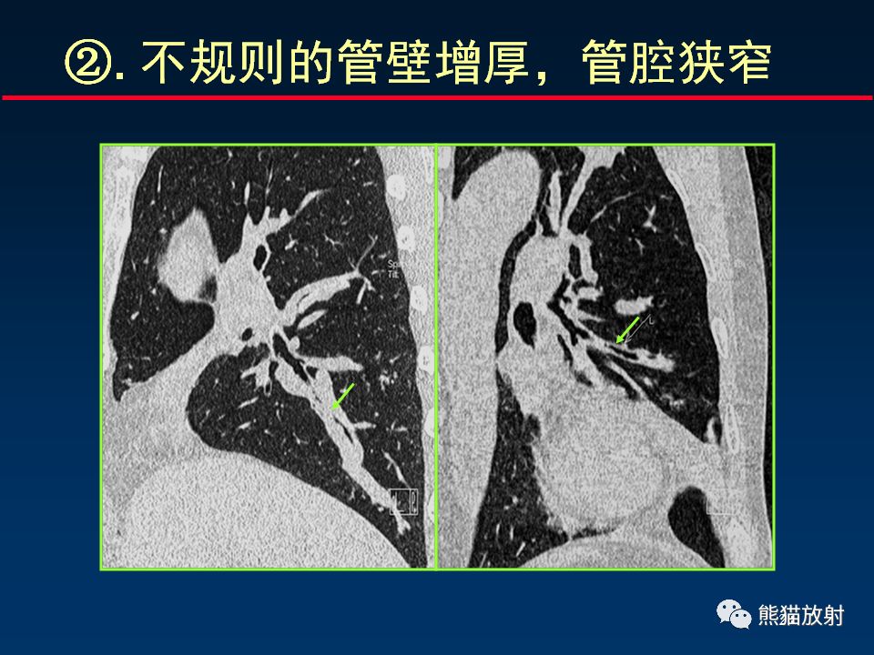 【PPT】正确判读支气管异常的CT征象 【PPT】正确判读支气管异常的CT征象
