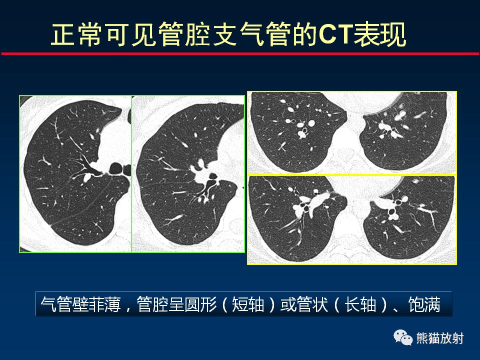 【PPT】正确判读支气管异常的CT征象 【PPT】正确判读支气管异常的CT征象