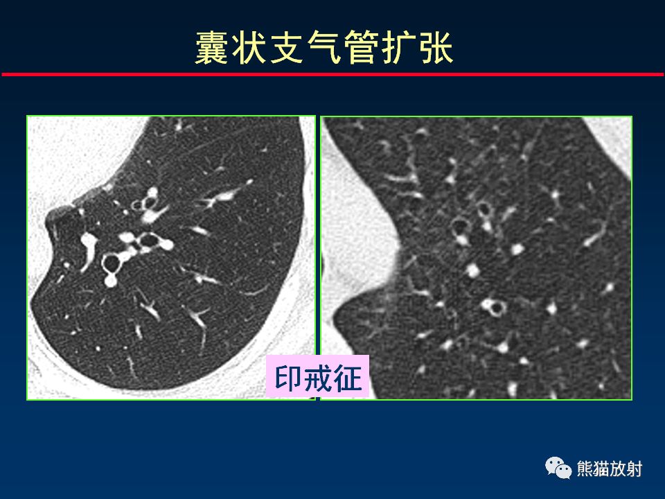 【PPT】正确判读支气管异常的CT征象 【PPT】正确判读支气管异常的CT征象