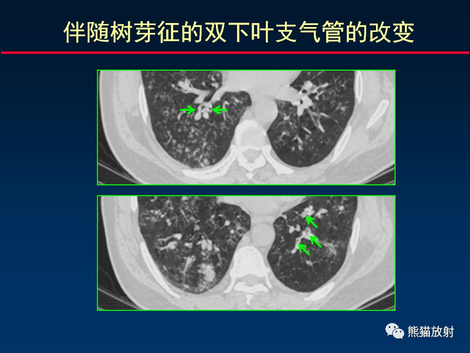 【PPT】正确判读支气管异常的CT征象 【PPT】正确判读支气管异常的CT征象