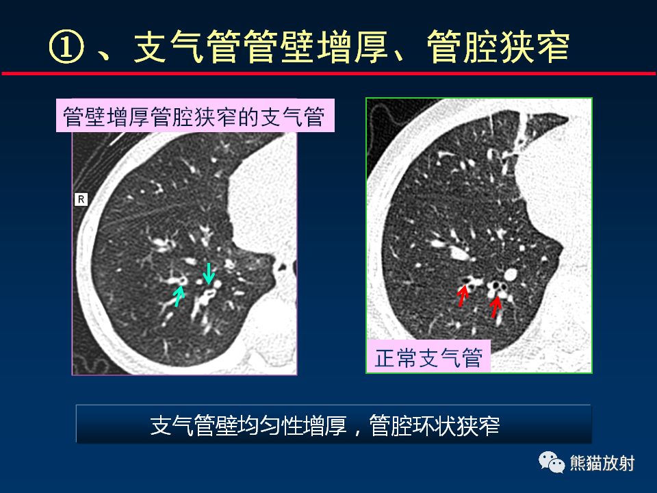 【PPT】正确判读支气管异常的CT征象 【PPT】正确判读支气管异常的CT征象