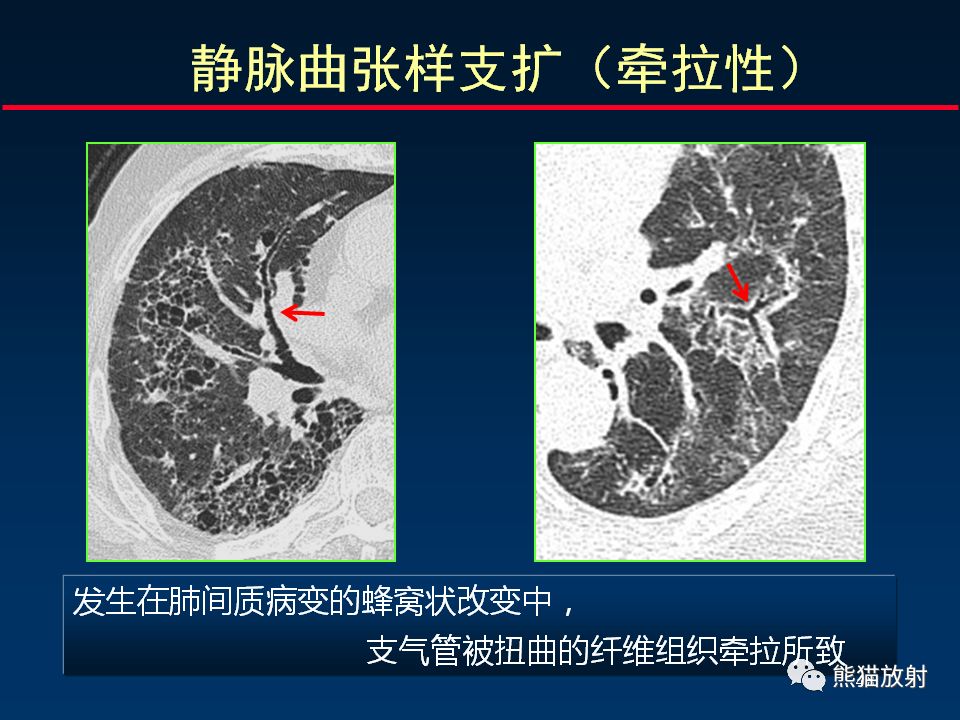【PPT】正确判读支气管异常的CT征象 【PPT】正确判读支气管异常的CT征象
