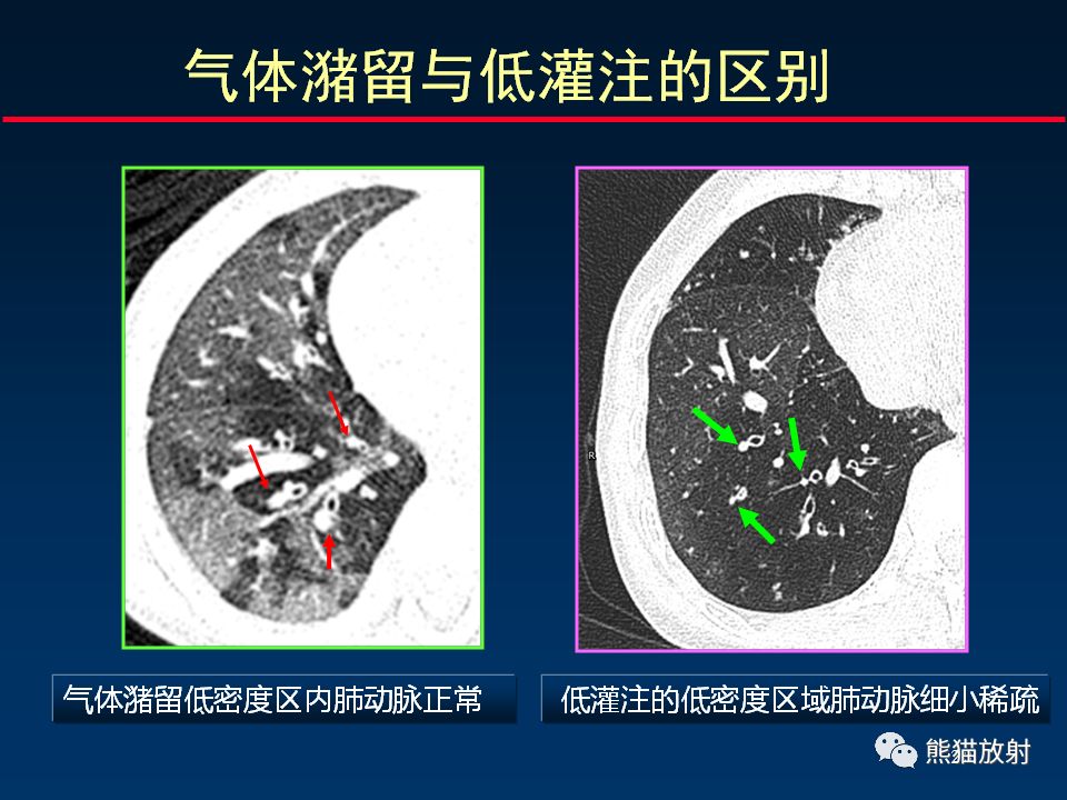 【PPT】正确判读支气管异常的CT征象 【PPT】正确判读支气管异常的CT征象