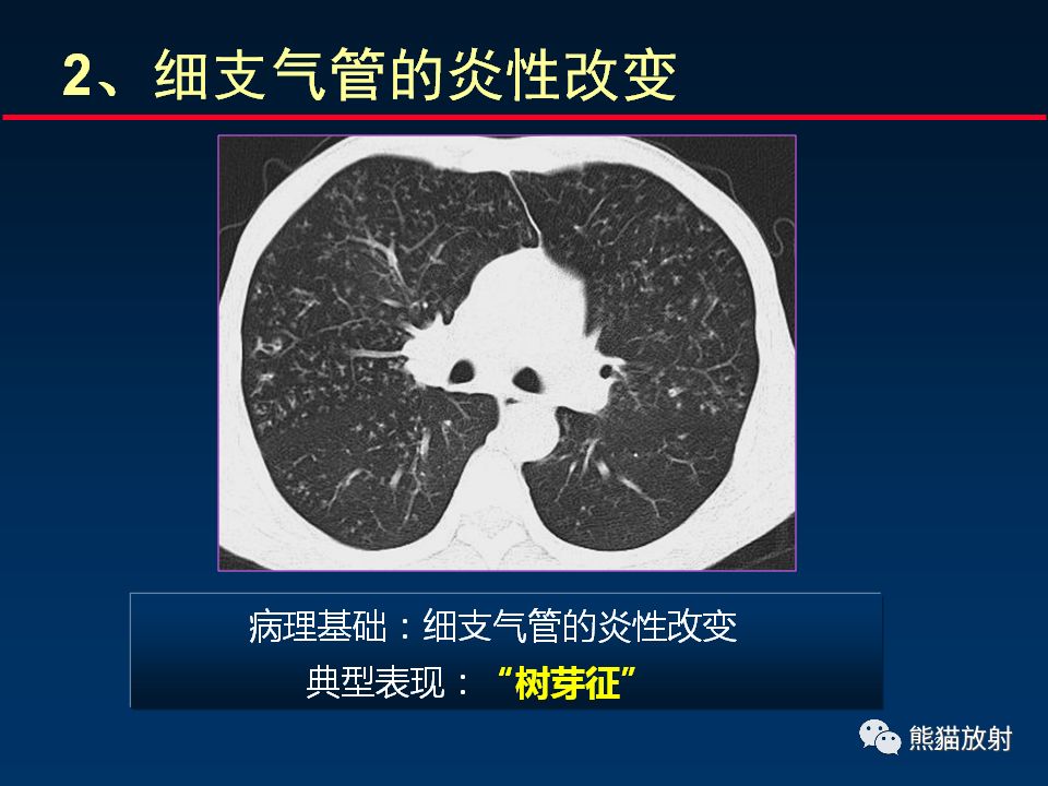 【PPT】正确判读支气管异常的CT征象 【PPT】正确判读支气管异常的CT征象