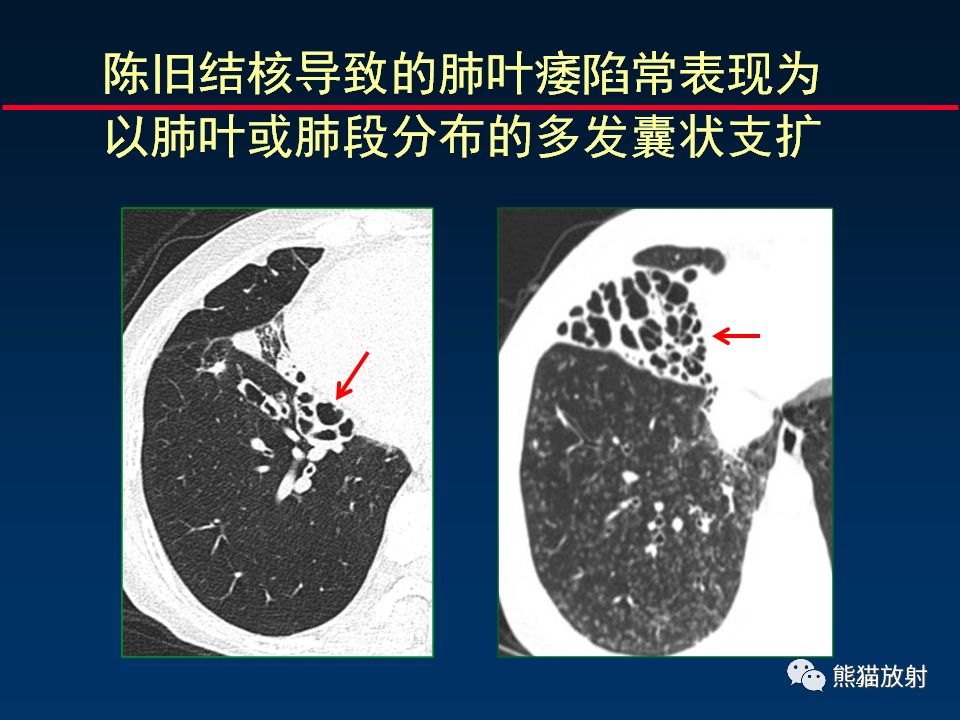 【PPT】正确判读支气管异常的CT征象 【PPT】正确判读支气管异常的CT征象
