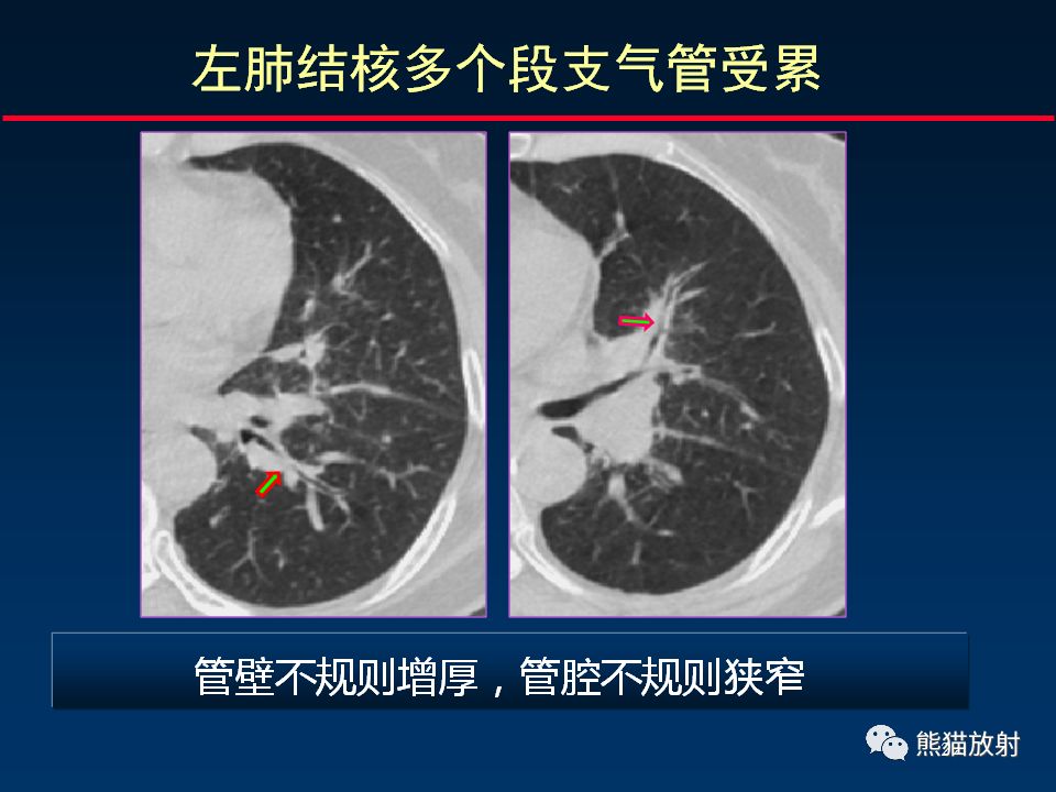 【PPT】正确判读支气管异常的CT征象 【PPT】正确判读支气管异常的CT征象