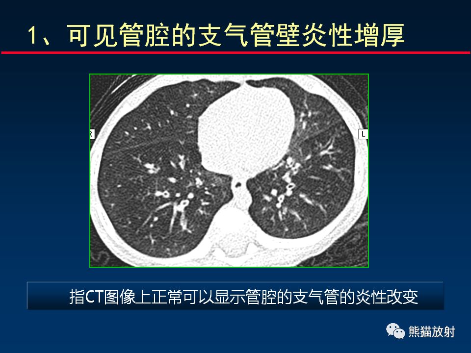 【PPT】正确判读支气管异常的CT征象 【PPT】正确判读支气管异常的CT征象