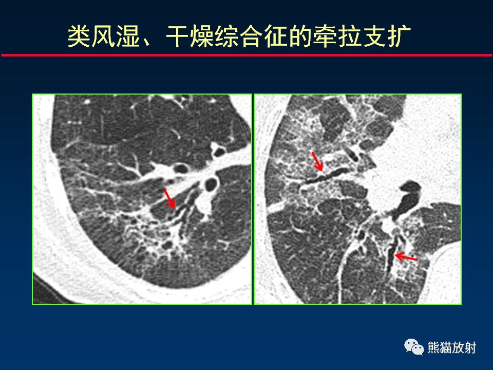 【PPT】正确判读支气管异常的CT征象 【PPT】正确判读支气管异常的CT征象