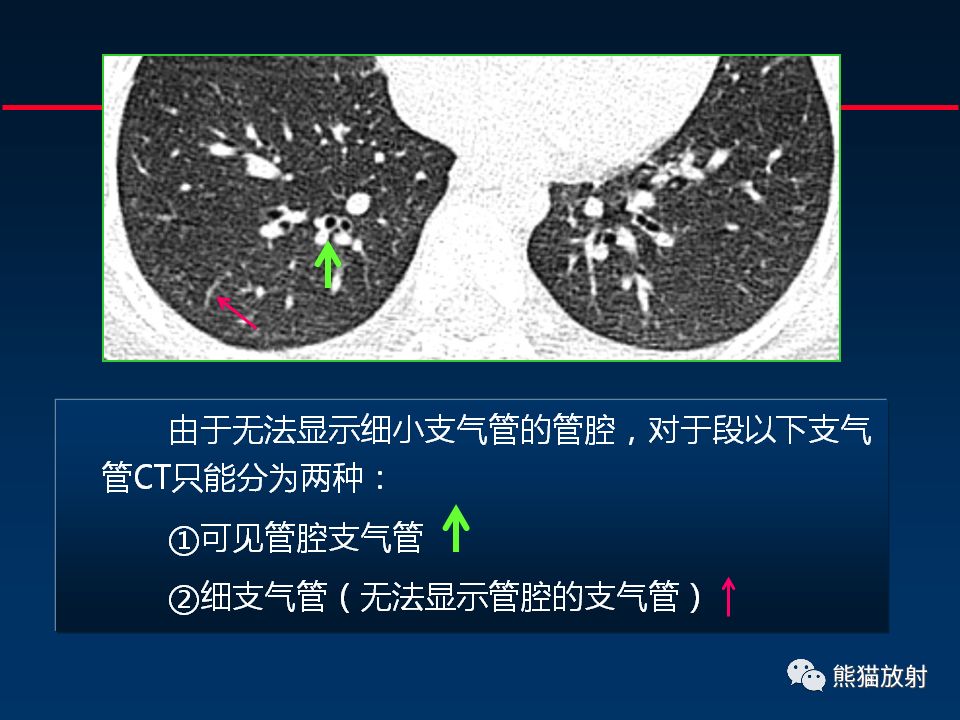 【PPT】正确判读支气管异常的CT征象 【PPT】正确判读支气管异常的CT征象