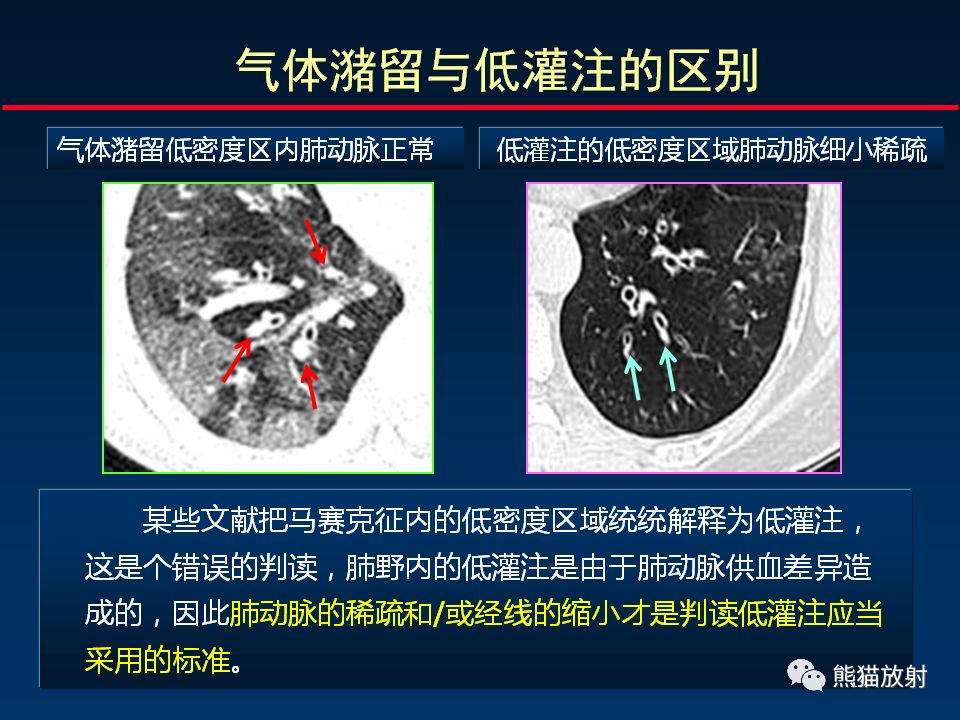 【PPT】正确判读支气管异常的CT征象 【PPT】正确判读支气管异常的CT征象