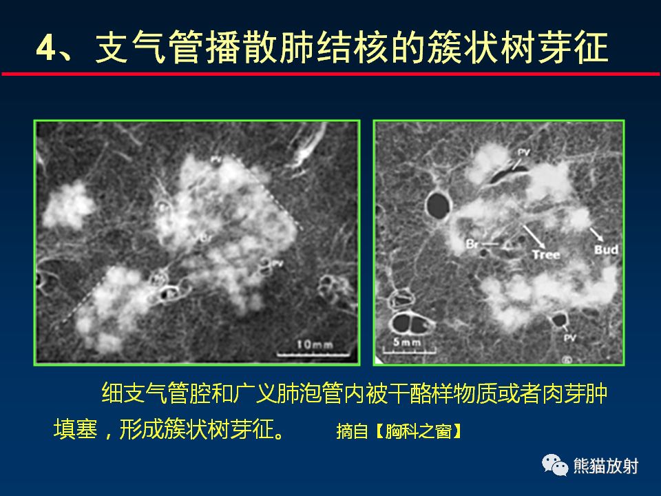 【PPT】正确判读支气管异常的CT征象 【PPT】正确判读支气管异常的CT征象
