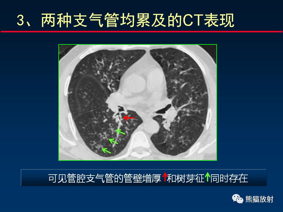 【PPT】正确判读支气管异常的CT征象 【PPT】正确判读支气管异常的CT征象