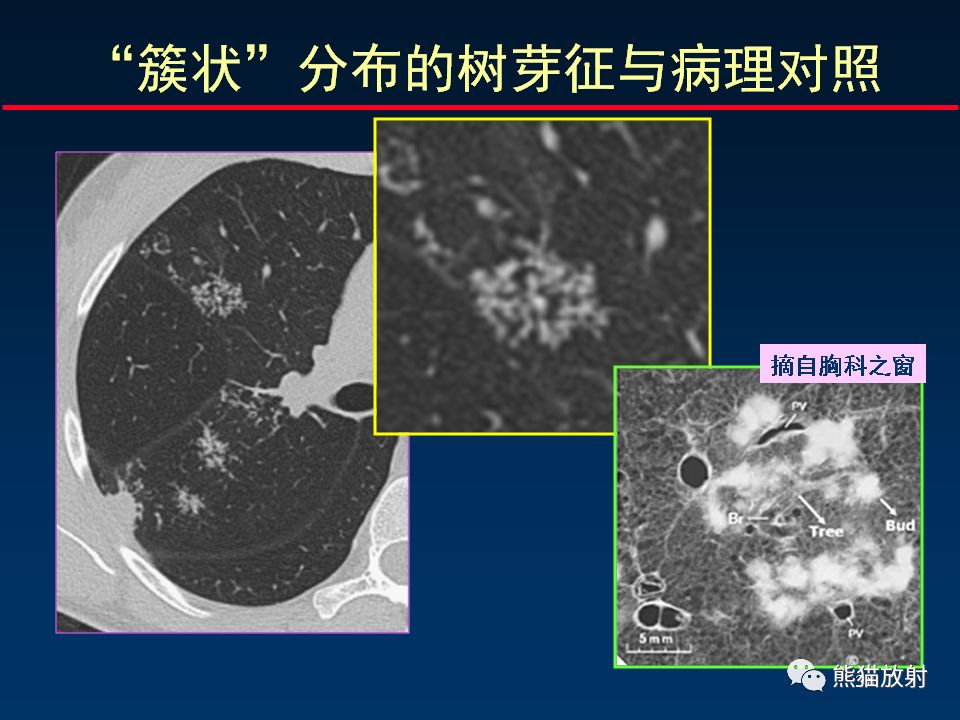 【PPT】正确判读支气管异常的CT征象 【PPT】正确判读支气管异常的CT征象