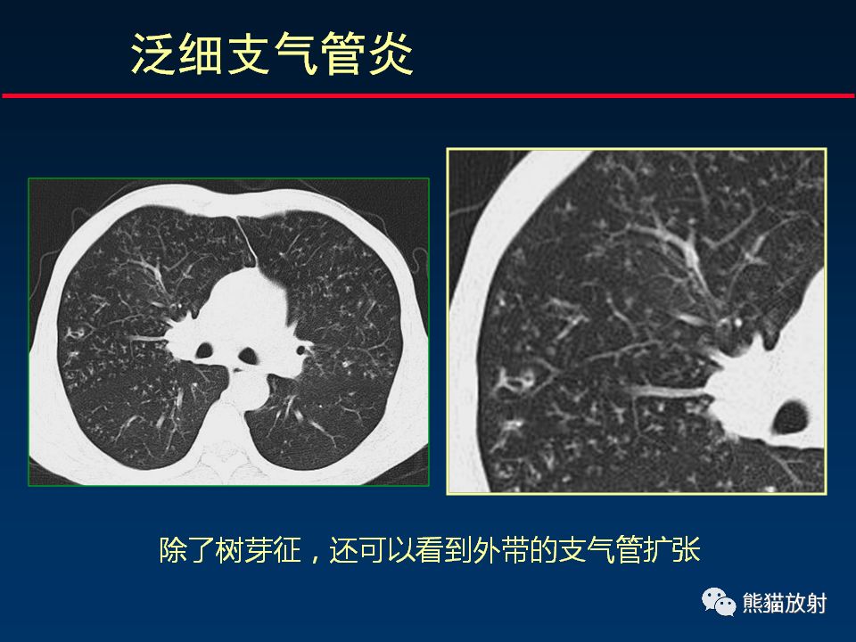 【PPT】正确判读支气管异常的CT征象 【PPT】正确判读支气管异常的CT征象